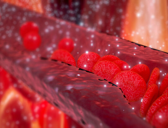 Cholesterol plaque blocking artery